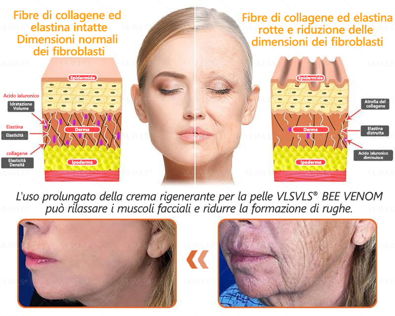 𝙑𝙇𝙎𝙑𝙇𝙎® VELENO D"API Crema rigenerante per la pelle – 🌸 Anti-age, Idratazione, Riparazione della pelle, Uniformità dell’incarnato, Trattamento per acne e macchie scure, Rimozione di verruche e nei, 𝐒𝐨𝐥𝐥𝐢𝐞𝐯𝐨 𝐝𝐚𝐥𝐥𝐚 𝐩𝐬𝐨𝐫𝐢𝐚𝐬𝐢