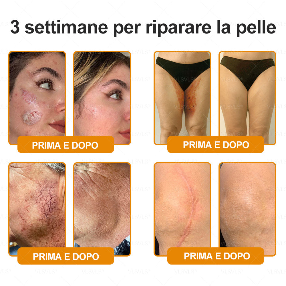 𝙑𝙇𝙎𝙑𝙇𝙎® VELENO D"API Crema rigenerante per la pelle – 🌸 Anti-age, Idratazione, Riparazione della pelle, Uniformità dell’incarnato, Trattamento per acne e macchie scure, Rimozione di verruche e nei, 𝐒𝐨𝐥𝐥𝐢𝐞𝐯𝐨 𝐝𝐚𝐥𝐥𝐚 𝐩𝐬𝐨𝐫𝐢𝐚𝐬𝐢