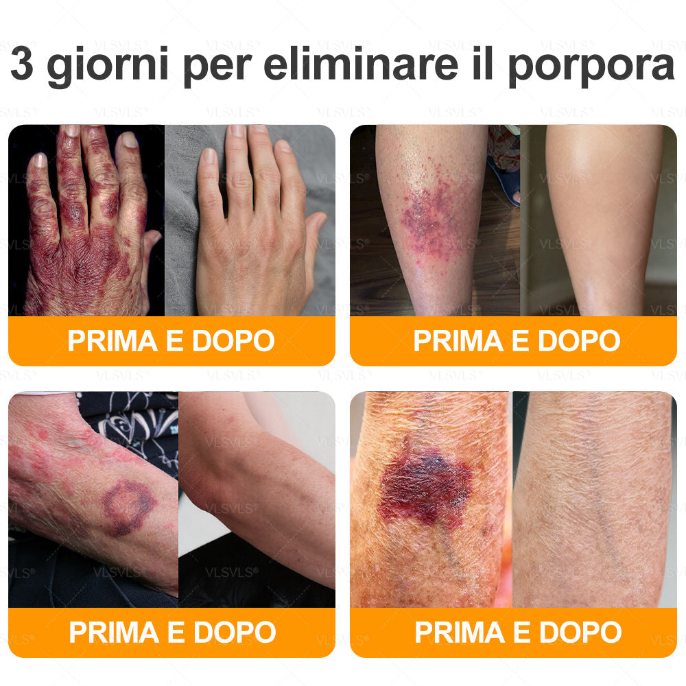 𝙑𝙇𝙎𝙑𝙇𝙎® VELENO D"API Crema rigenerante per la pelle – 🌸 Anti-age, Idratazione, Riparazione della pelle, Uniformità dell’incarnato, Trattamento per acne e macchie scure, Rimozione di verruche e nei, 𝐒𝐨𝐥𝐥𝐢𝐞𝐯𝐨 𝐝𝐚𝐥𝐥𝐚 𝐩𝐬𝐨𝐫𝐢𝐚𝐬𝐢